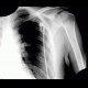 Bone infarct, secondary finding: X-ray - Plain radiograph